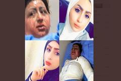 La joven Malak Haidar al Zubaidi, antes y después del ataque.